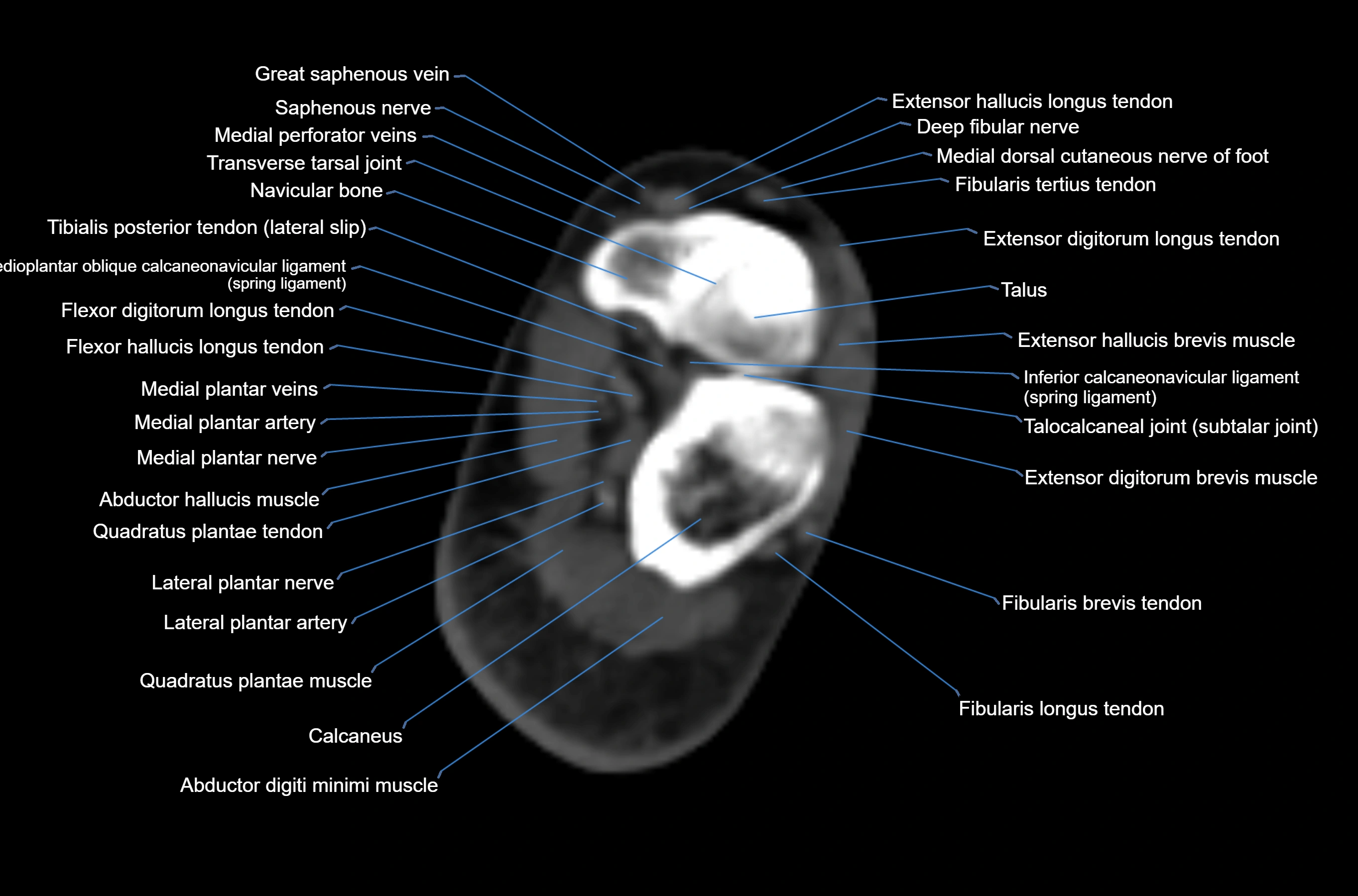 CT Ankle axial cross sectional anatomy labelled image -00044.webp